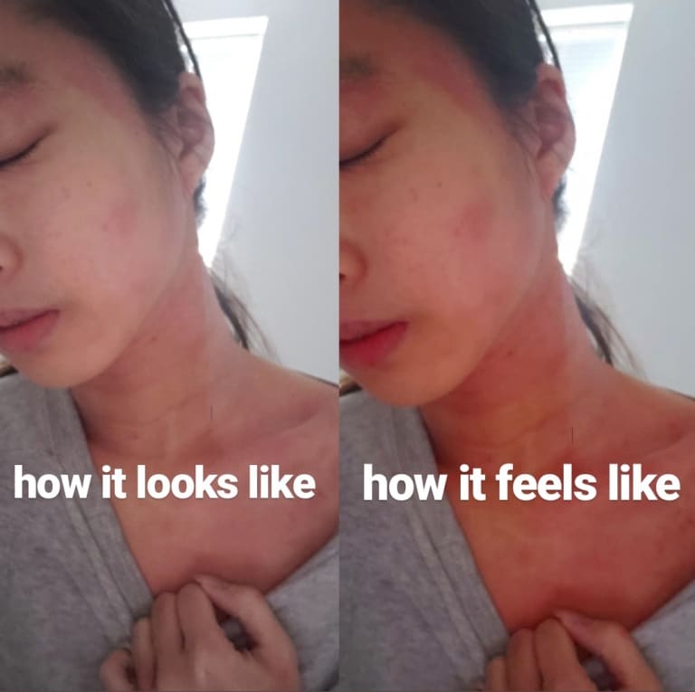 My Current Eczema Condition (March 2019) â Eczema Warrior by Kim C