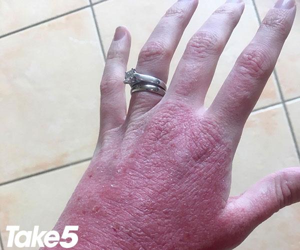 My eczema flared up after stopping steroids, before my wedding