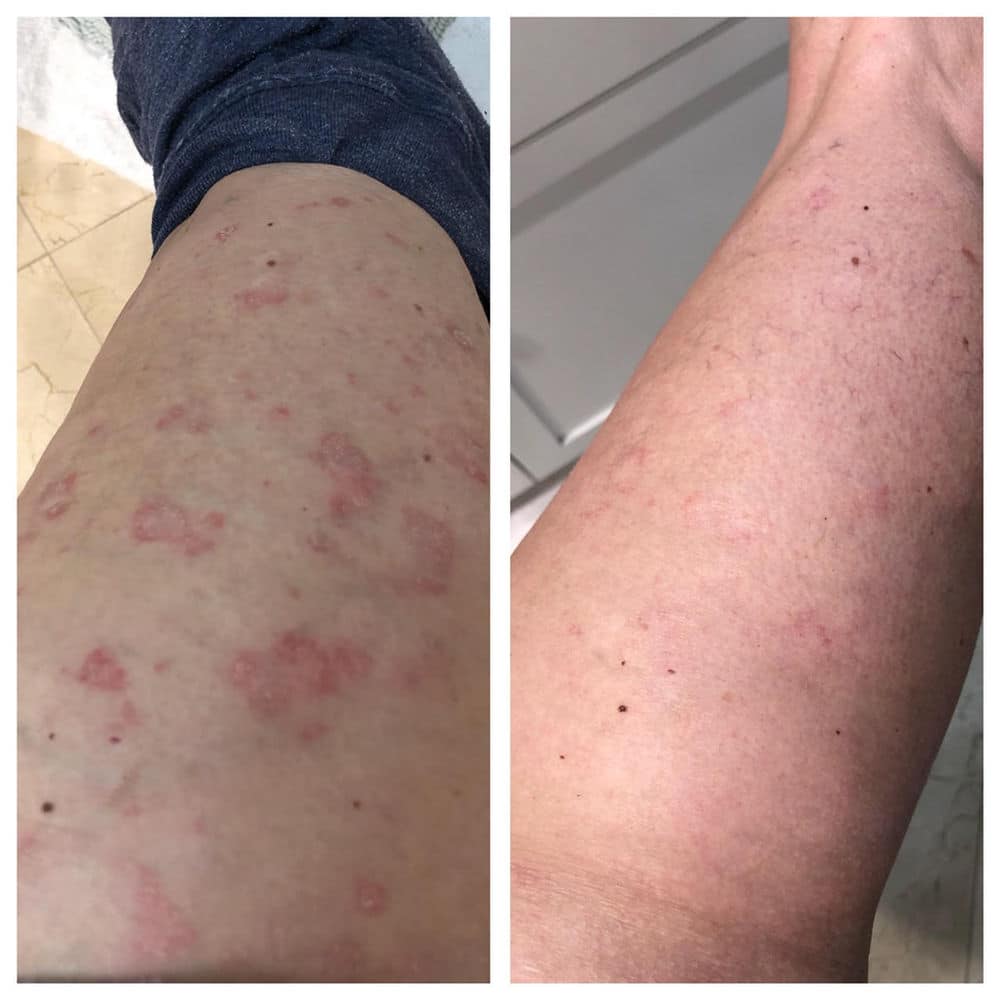 My Journey with Eczema