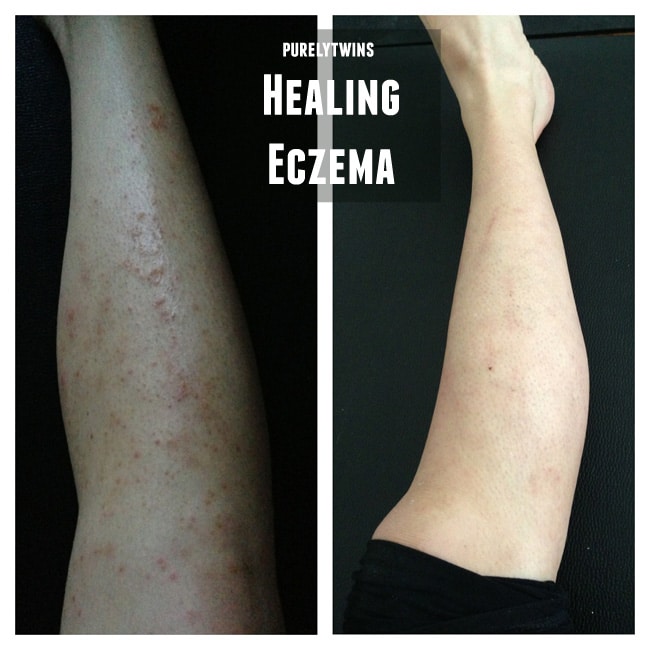 my long journey to healing eczema and the new diet that has helped