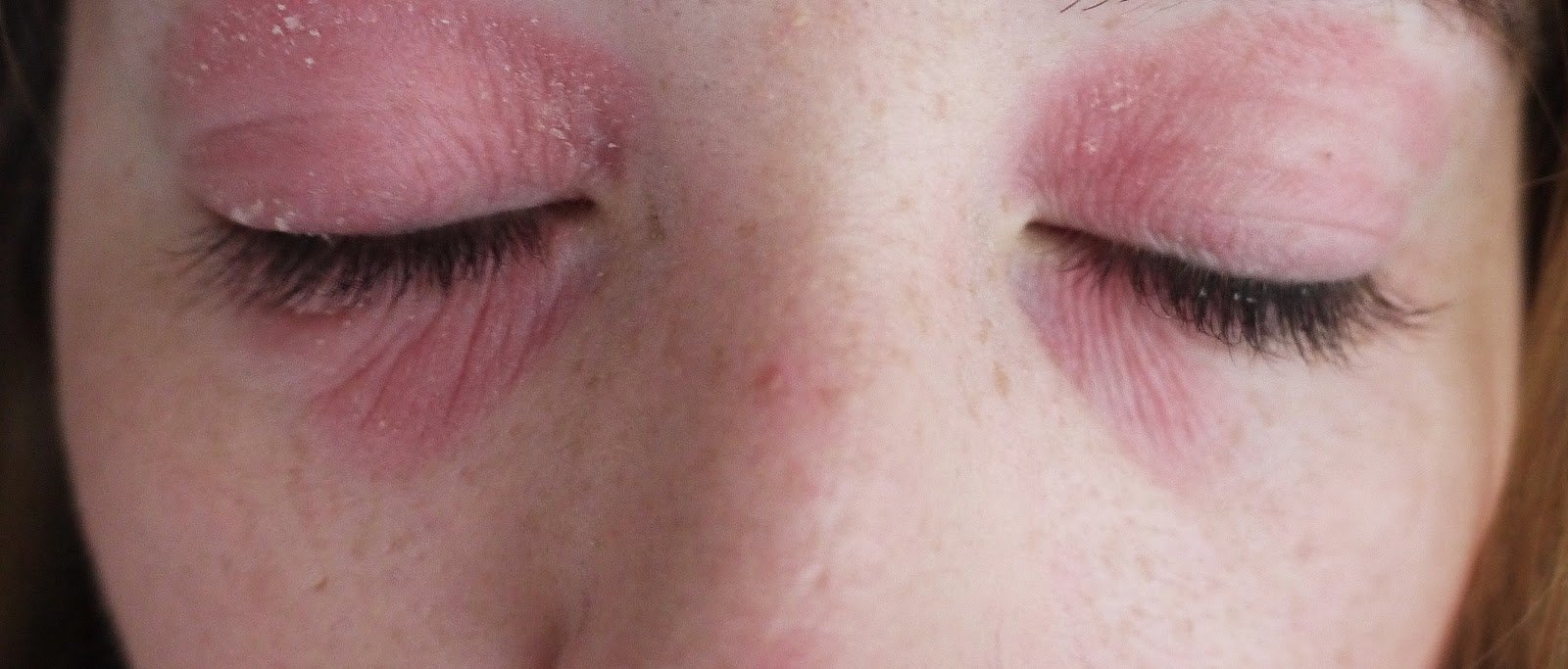 My Struggle With Eczema On Face and Eyes &  My Miracle ...