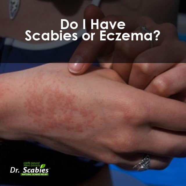 narrowsdesigns: How Do I Know If I Have Scabies Or Eczema