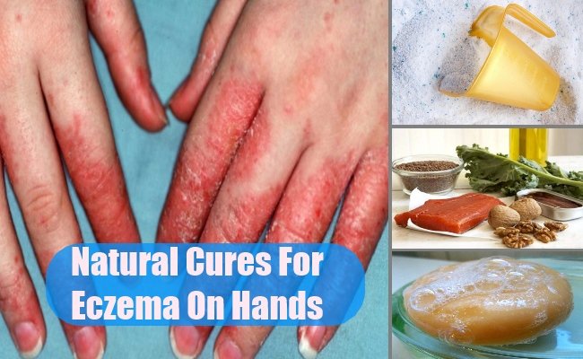 Natural Cures For Eczema On Hands