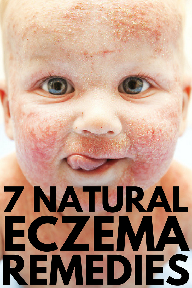 Natural eczema treatment: 7 natural ways to treat eczema ...