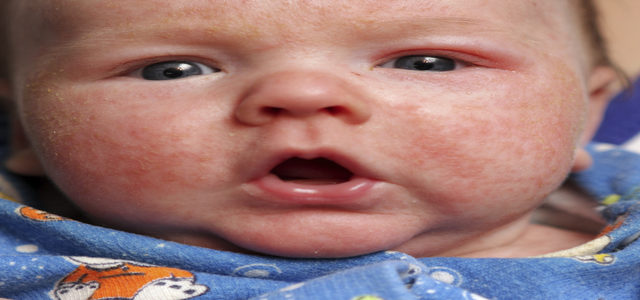 Natural Ways To Help Baby Eczema