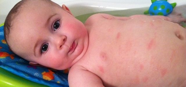 Natural Ways To Treat Baby Eczema