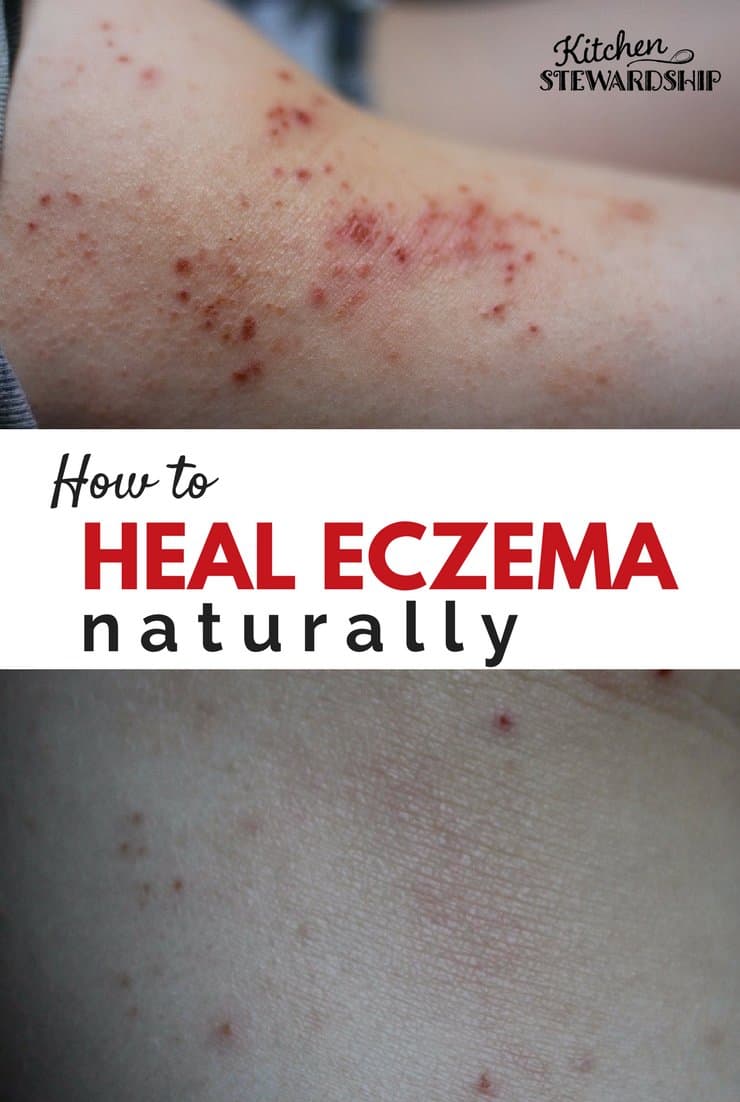 Naturally Soothing your Eczema Without Giving up all the ...