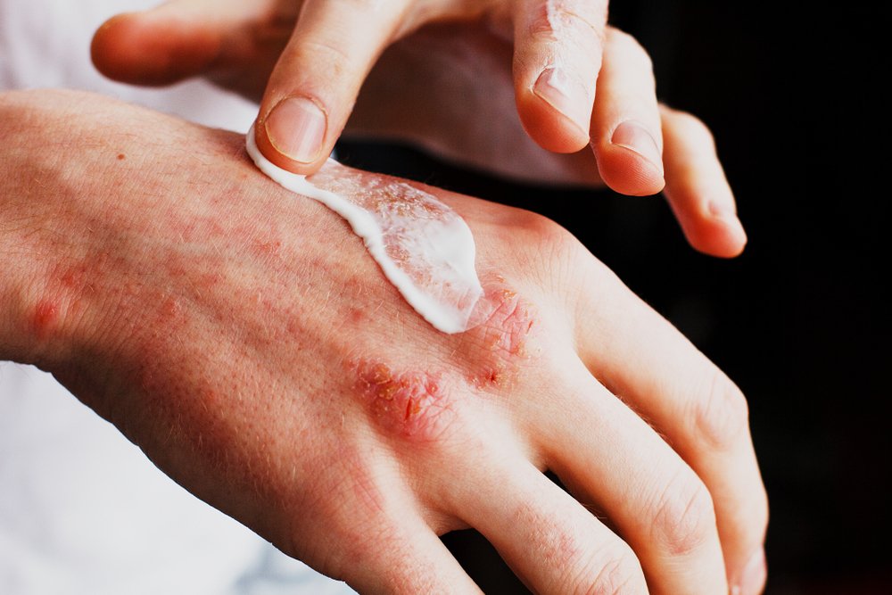 Neurodermatitis (Eczema): Symptoms of The Skin Disease ...