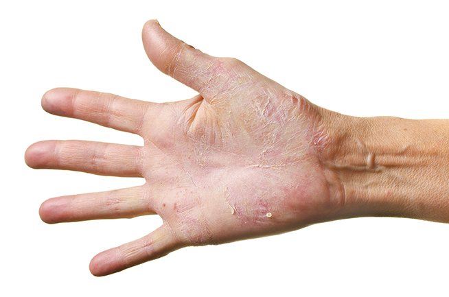New study shows hand eczema is more common among healthcare workers