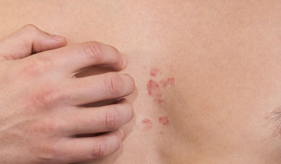 New Use For BOTOX: Eczema Treatment?