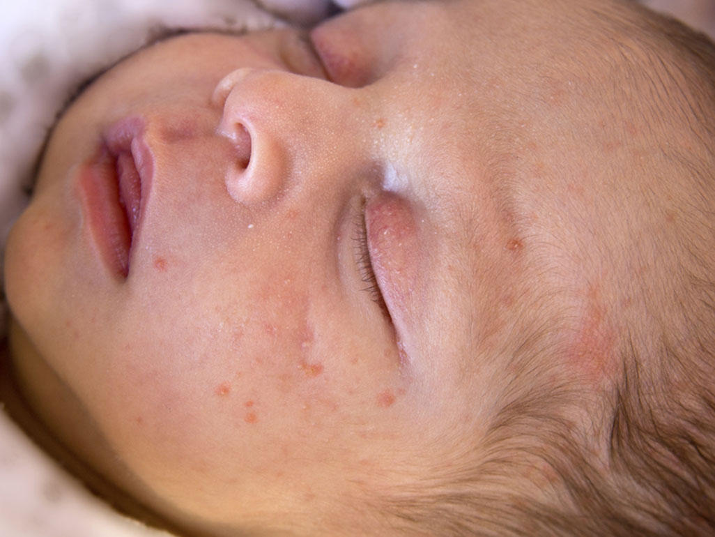 Newborn and baby rashes: Eczema, acne, &  other skin conditions