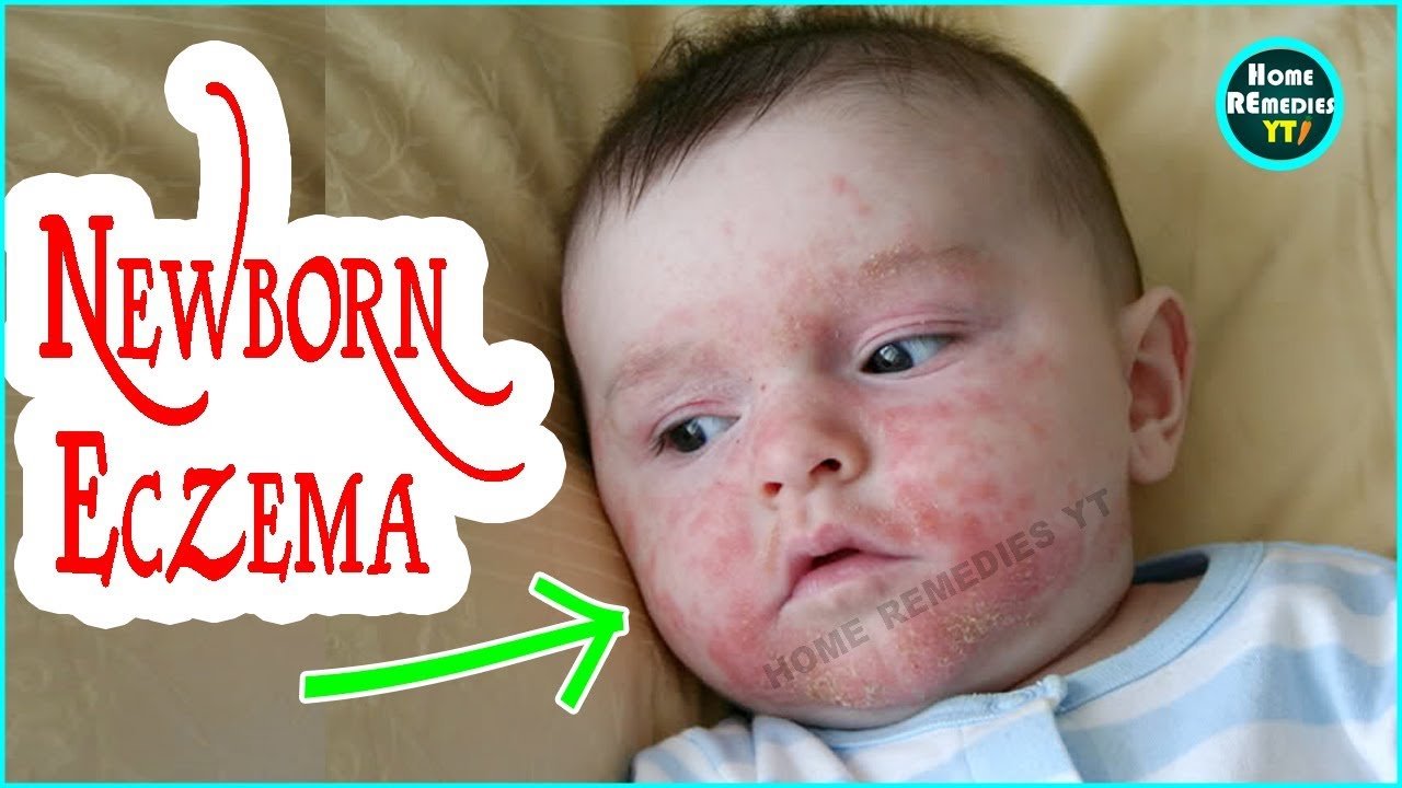Newborn Eczema Causes and Symptoms