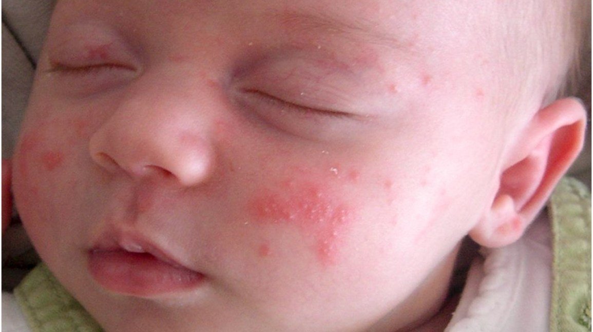 Newborn Skin Rash: Understanding The Mystery Behind Newborn Eczema