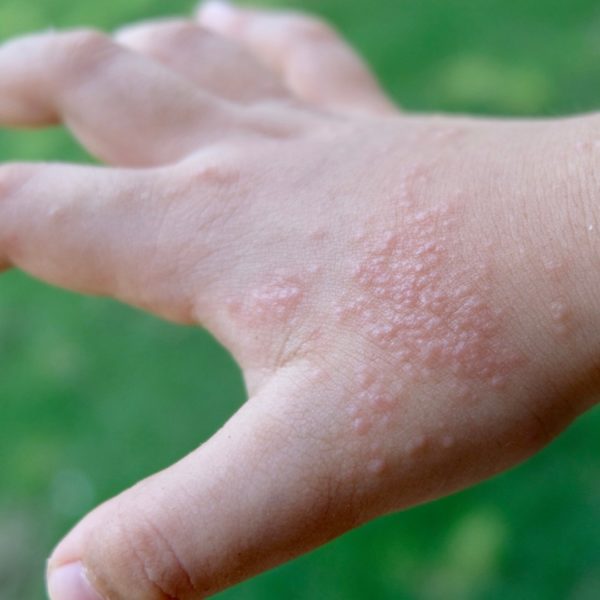 Novel Treatments for Chronic Itch, Eczema and Skin Infections