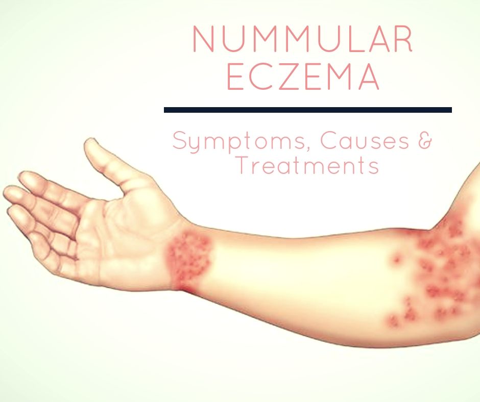 Nummular Dermatitis Eczema Diagnosis &  Treatments ...