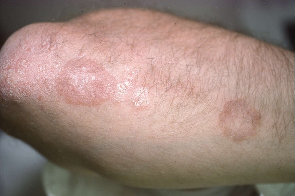 Nummular Eczema: 10 Symptoms Of Nummular Eczema