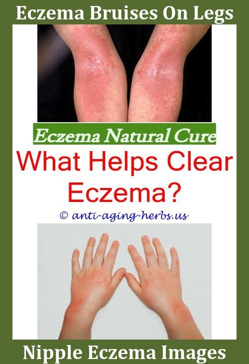 Nummular Eczema Eczema Behind Knees What Foods Not To Eat ...
