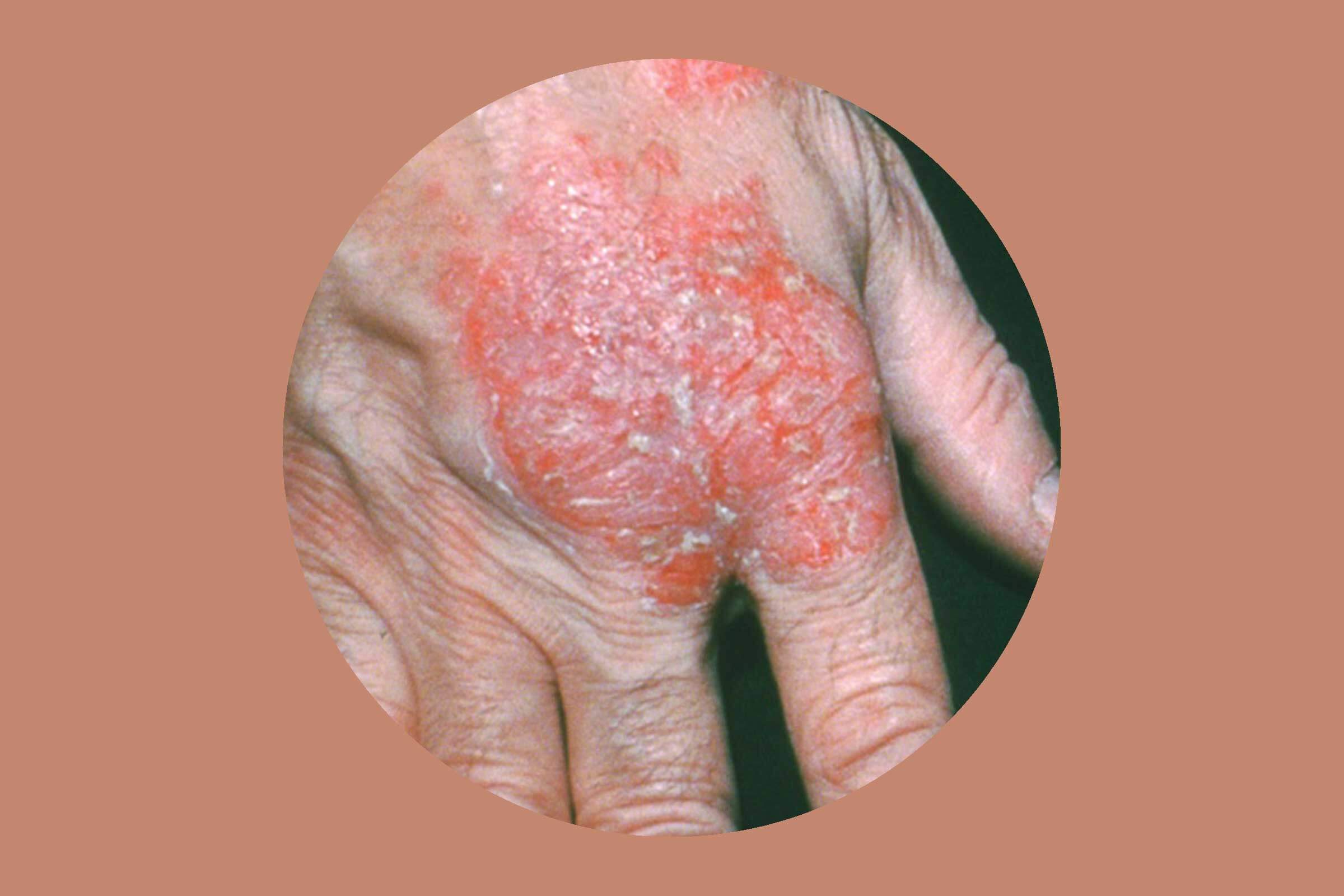Nummular Eczema: How to Get Rid of It for Good