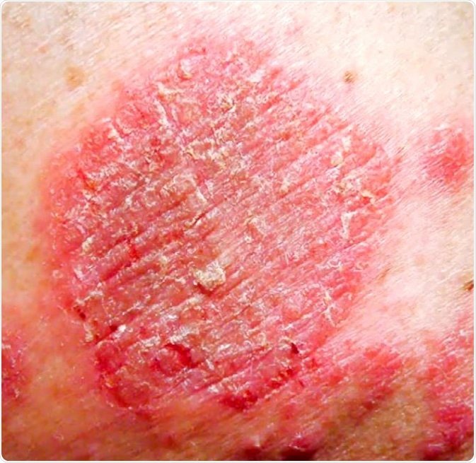 Nummular Eczema Treatment Over The Counter