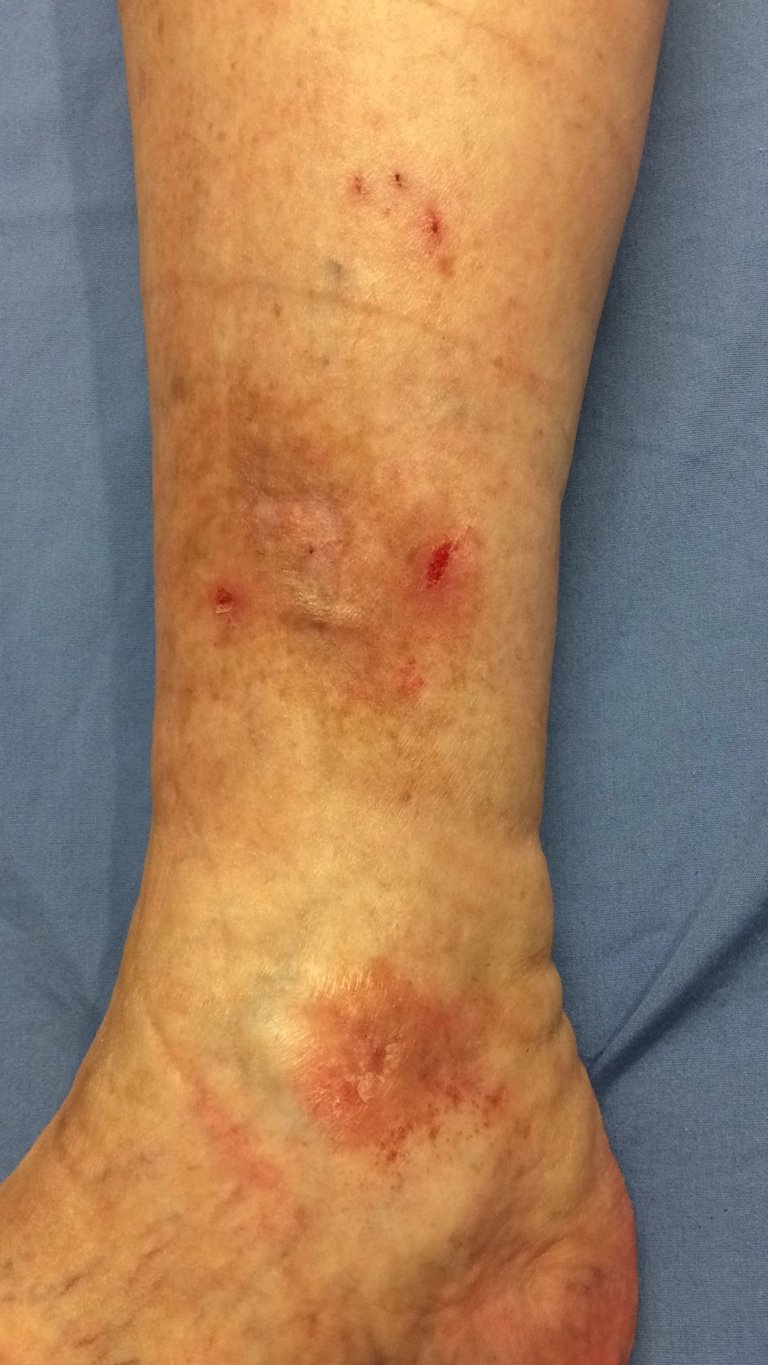 Open Sores on Legs That Wont Heal: Itchy &  Red [Picture ...