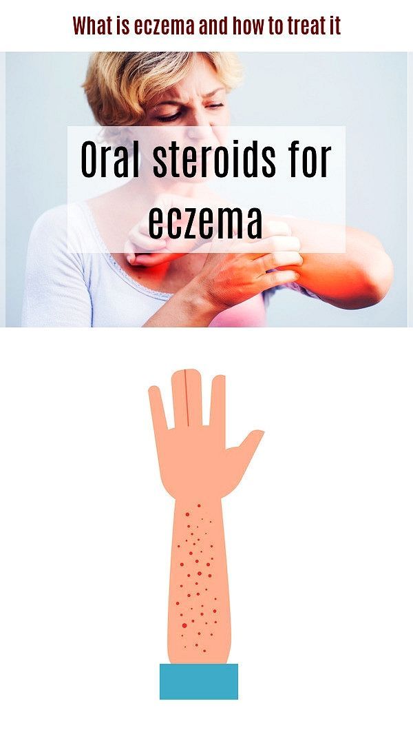 Oral steroids for eczema. Eczema is a relatively rare skin ...