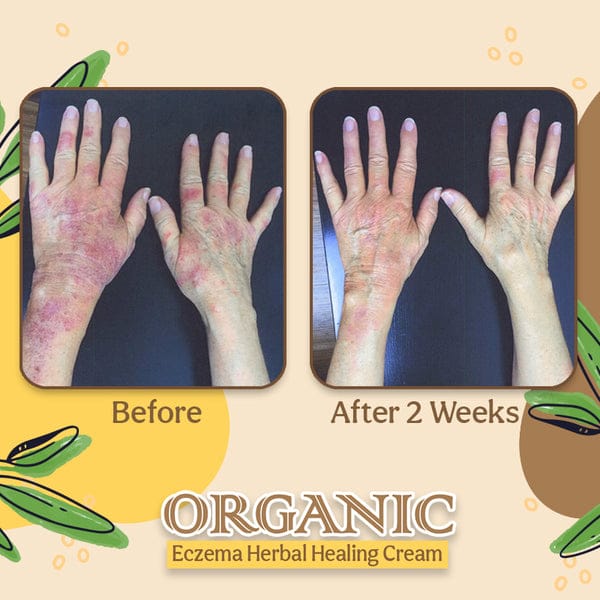 Organic Eczema Herbal Healing Cream  Harmoninic