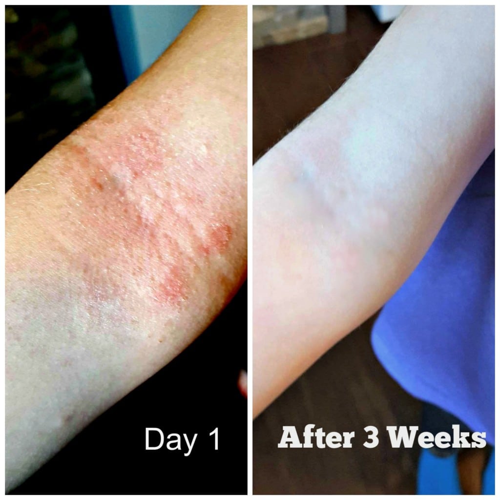 Our Eczema Story and How Nutratopic, by Intega Skin Sciences Has Helped ...