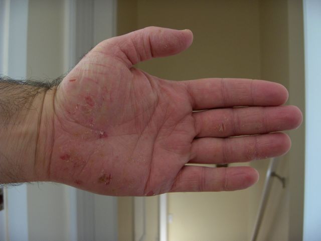 Painful and dry cracked hands are reliably treated with ...