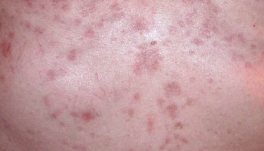 Papular eczema: Symptoms, causes, and treatment