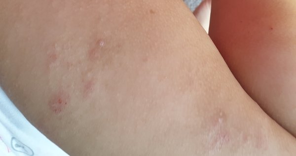 Patchy rash/possibly eczema on my 2 years olds skin