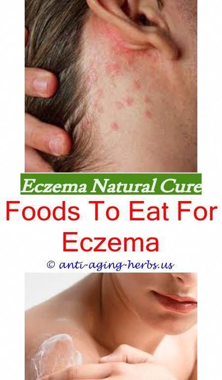 pediatric eczema 2 year old eczema getting worse