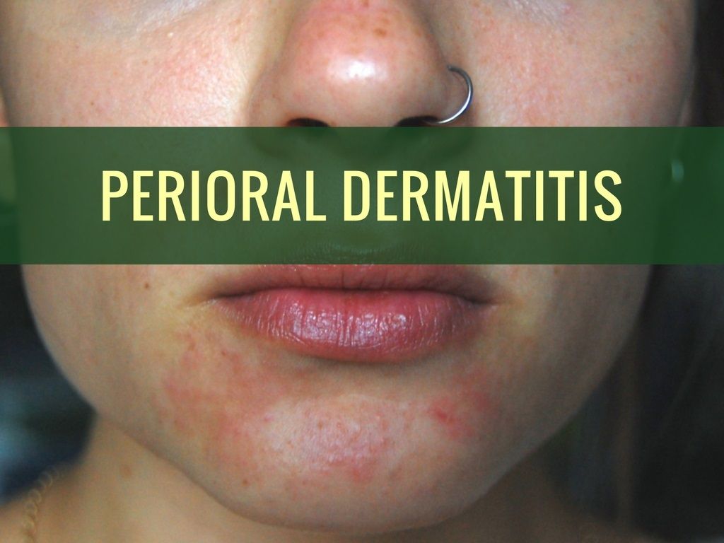 Perioral dermatitis: Causes, Symptoms and Treatments ...