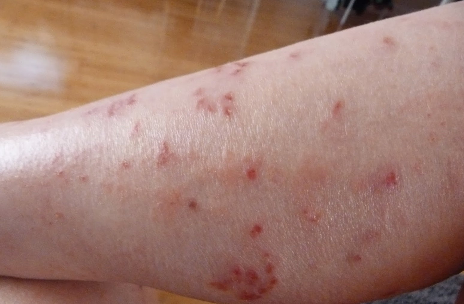Photos of Eczema on Adults Legs ~ Treatment for Eczema