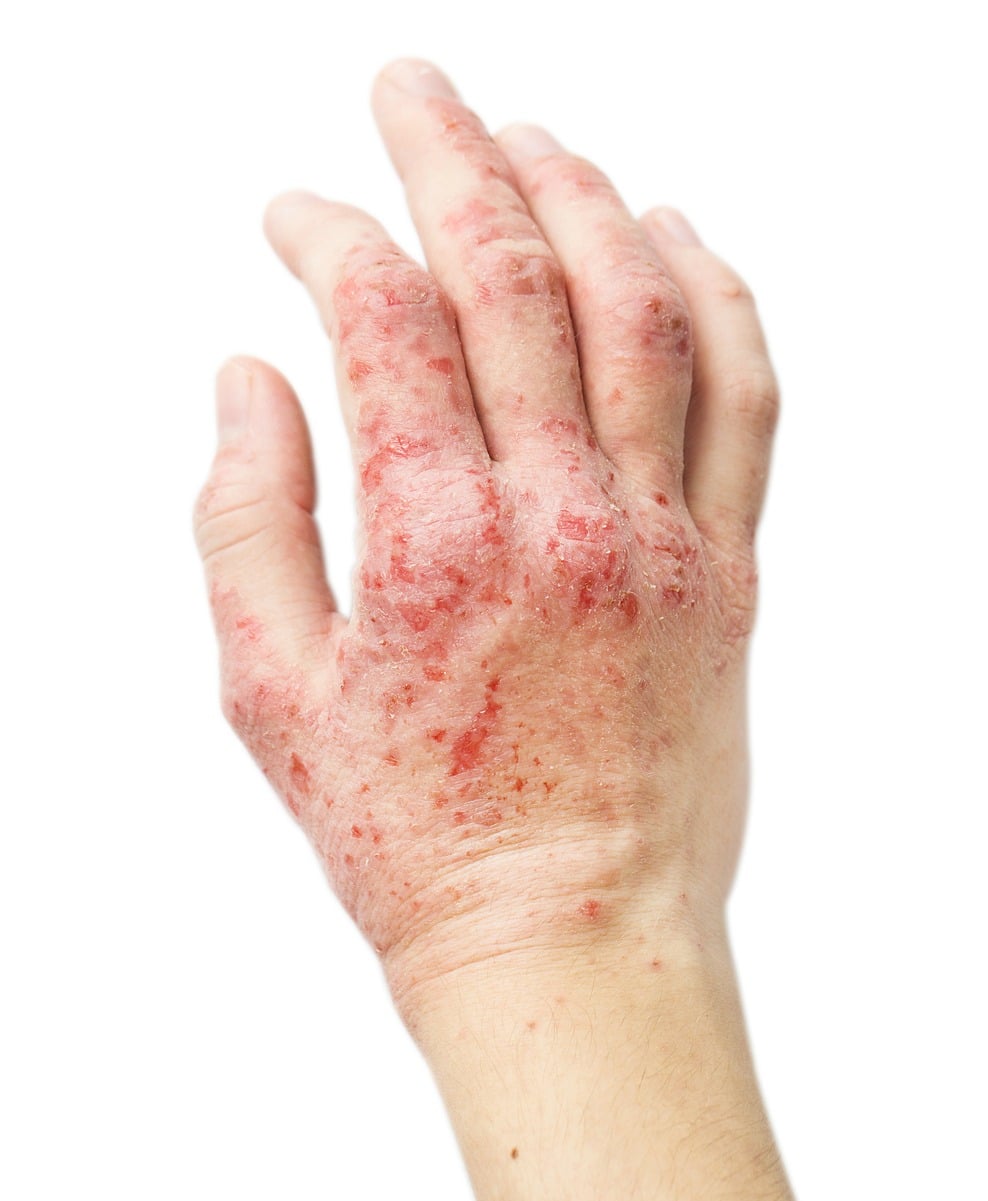 Pictures of Eczema
