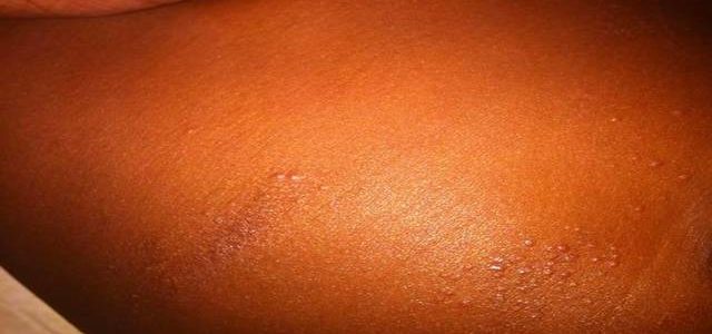 Pictures Of Eczema In Black Babies