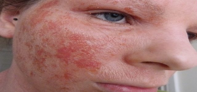 Pictures Of Eczema On Face Adults