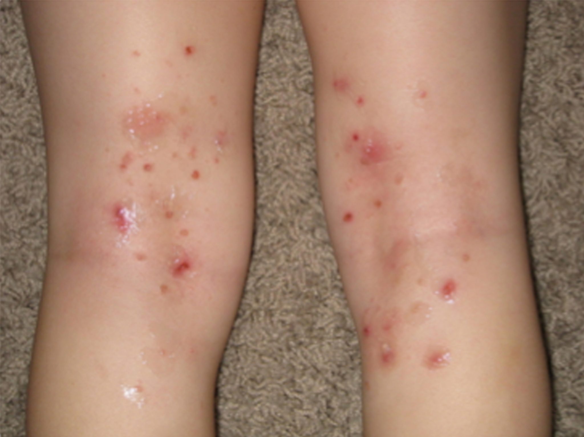 Pictures of Eczema on Legs