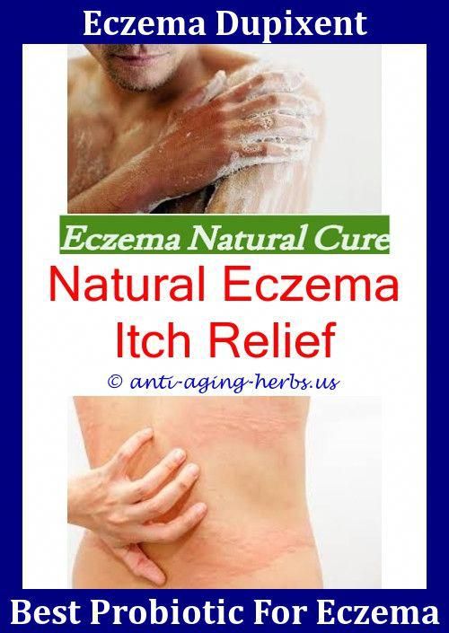 Pin by Chevy97 on eczema ideas