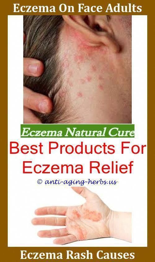 Pin on Best Eczema Treatment For Adults