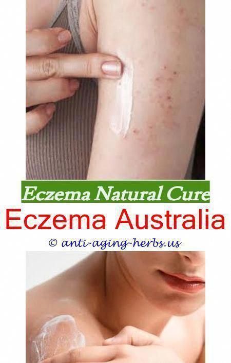 Pin on Eczema Cure Treatment