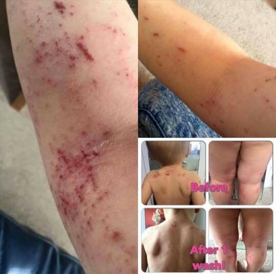 Pin on Eczema, Itchy Skin and Allergy