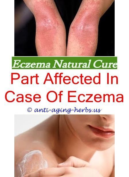 Pin on Eczema Routine