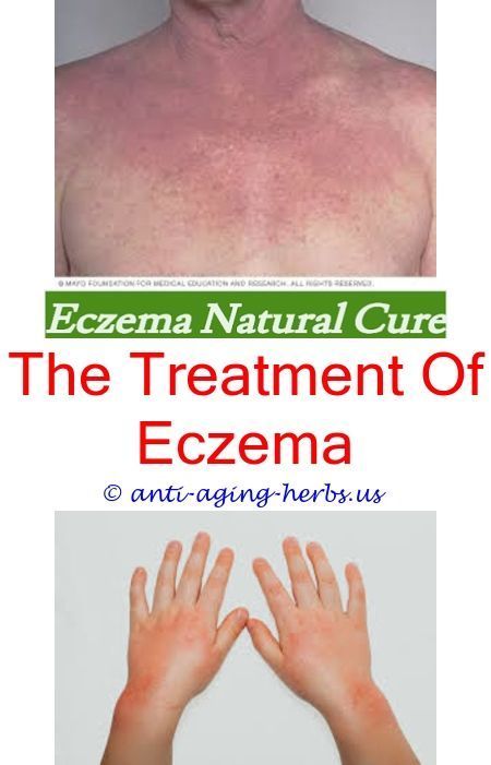 Pin on Eczema Treatment