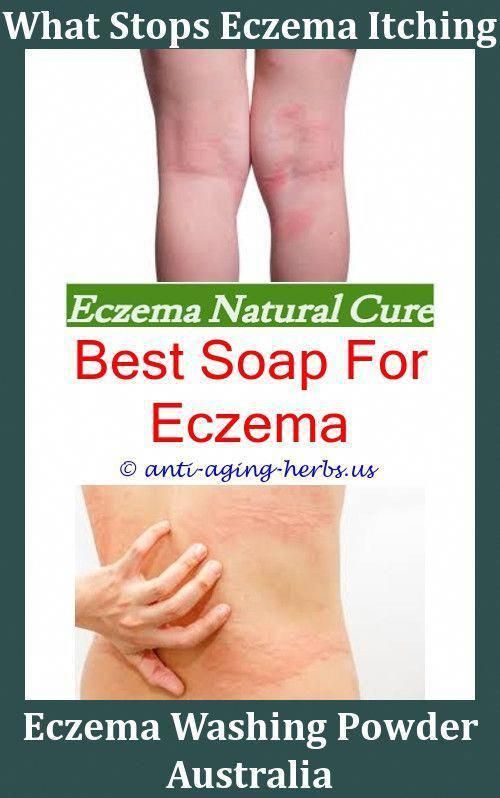 Pin on The Treatment Of Eczema