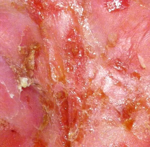 Pompholyx (dyshidrotic eczema)
