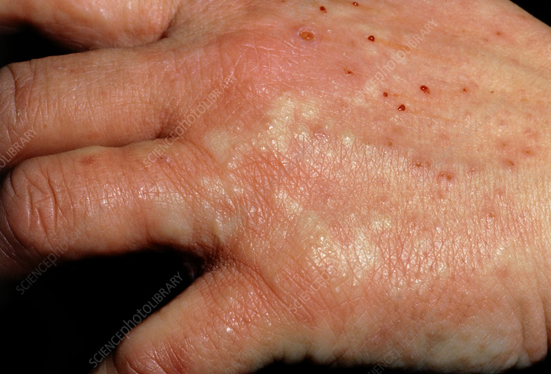 Pompholyx (eczema) of hands with urticaria