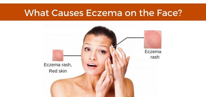Possible Causes &  Natural Treatments for Eczema on the Face