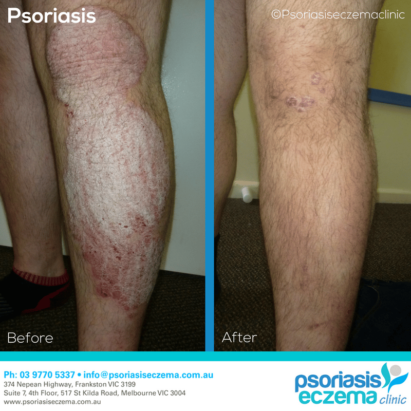 Psoriasis Before and After Results! At the Psoriasis Eczema Clinic, we ...
