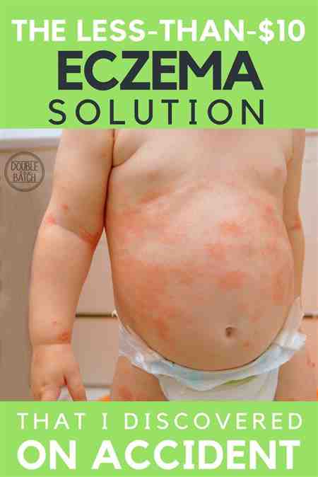 Psoriasis Extremely Itchy Infant Acne Baby