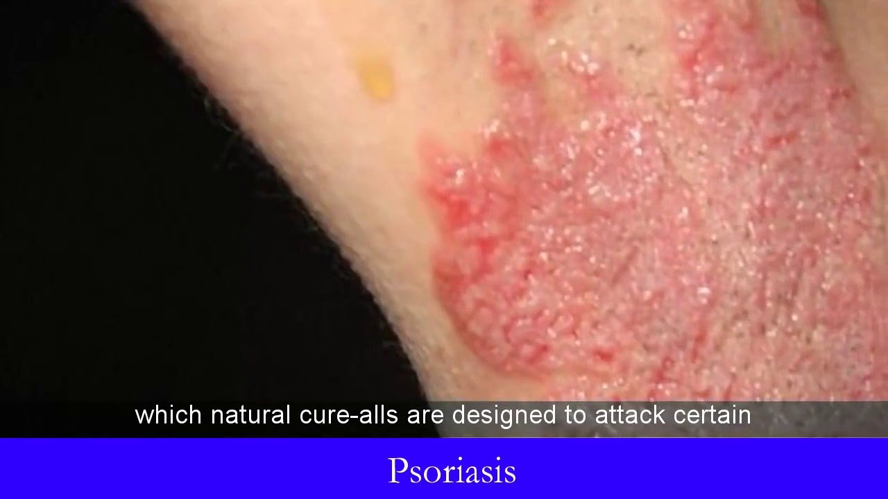 Psoriasis Groin Cure